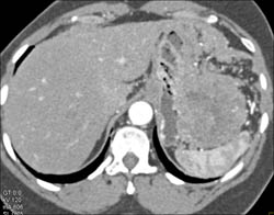 Gastric Adenocarcinoma With Implants - CTisus CT Scan