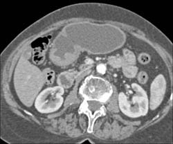 Antral Carcinoma - CTisus CT Scan