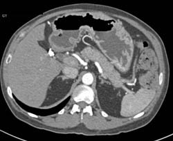 Gastritis - CTisus CT Scan