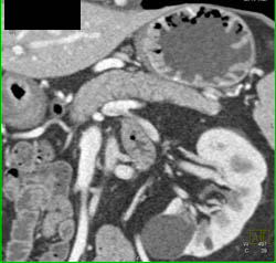 Gastritis - CTisus CT Scan