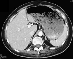 Gastric Outlet Obstruction Due to Tumor - CTisus CT Scan