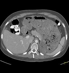 Stomach Full of Food Due to Gastric Outlet Obstruction - CTisus CT Scan
