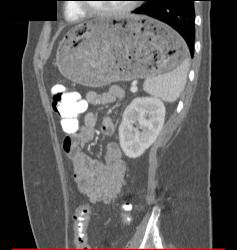 Stomach Full of Food Due to Gastric Outlet Obstruction - CTisus CT Scan