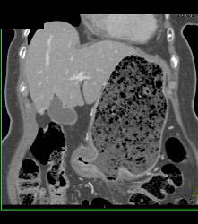Infiltrating Gastric Cancer in Multiple Views - CTisus CT Scan