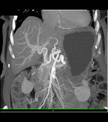 Infiltrating Gastric Cancer in Multiple Views - CTisus CT Scan