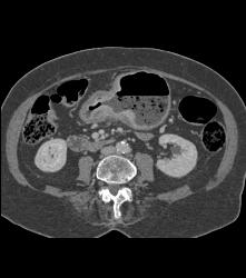Infiltrating Gastric Cancer in Multiple Views - CTisus CT Scan