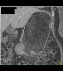 Infiltrating Gastric Cancer in Multiple Views - CTisus CT Scan