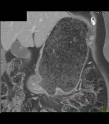 Infiltrating Gastric Cancer in Multiple Views - CTisus CT Scan