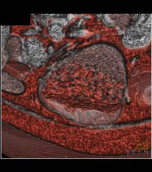 Infiltrating Gastric Cancer in Multiple Views - CTisus CT Scan