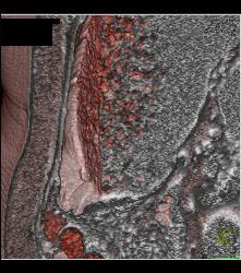 Infiltrating Gastric Cancer in Multiple Views - CTisus CT Scan