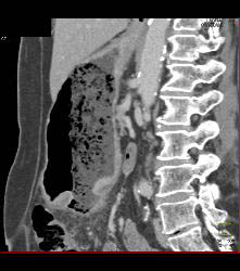 Infiltrating Gastric Cancer in Multiple Views - CTisus CT Scan