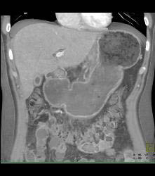Gastric Carcinoma With Celiac Nodes - CTisus CT Scan