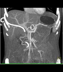 Gastric Carcinoma With Celiac Nodes - CTisus CT Scan