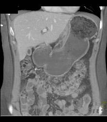 Gastric Carcinoma With Celiac Nodes - CTisus CT Scan