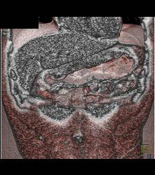 Bulky Gastric Cancer - CTisus CT Scan