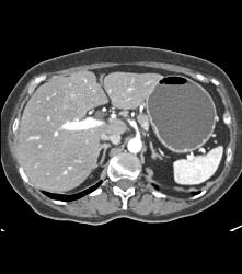 Antral Carcinoma - CTisus CT Scan