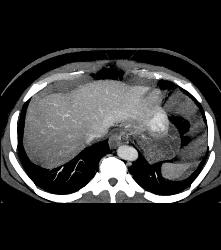Glomus Tumor - CTisus CT Scan