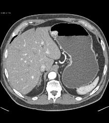 Glomus Tumor - CTisus CT Scan