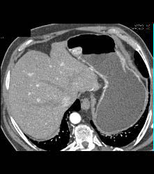 Glomus Tumor - CTisus CT Scan