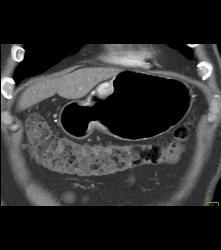 Glomus Tumor - CTisus CT Scan
