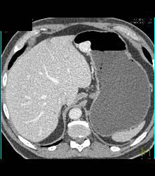 Glomus Tumor - CTisus CT Scan