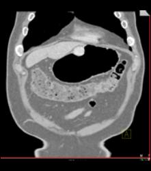 Glomus Tumor - CTisus CT Scan