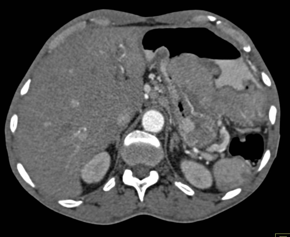 Exophytic Gastric Mass that was an usual Plasmocytoma - CTisus CT Scan