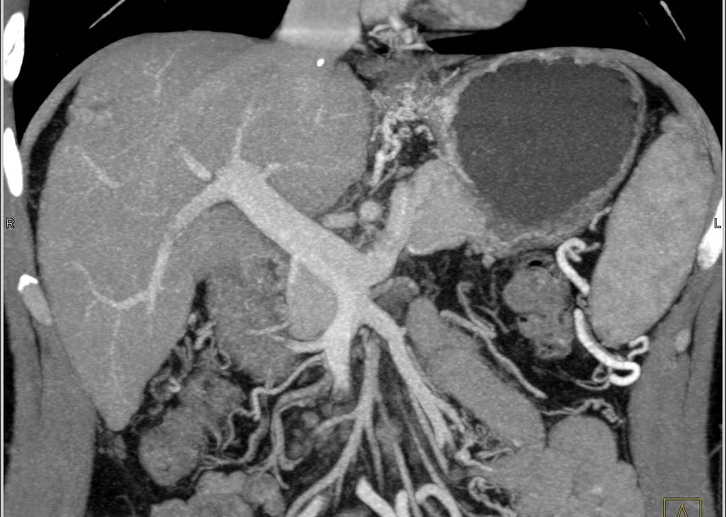 Subtle Carcinoma at Gastroesophageal (GE) Junction in Patient with Cirrhosis and Portal Hypertension - CTisus CT Scan