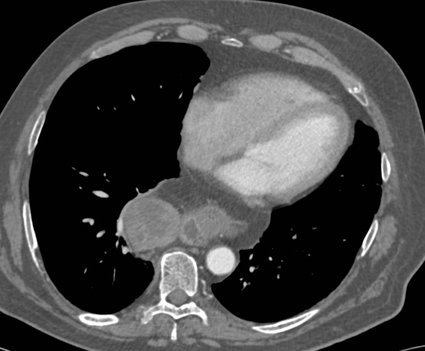 Gastric Cancer Arises in Gastric Fundus in an Hiatal Hernia - CTisus CT Scan