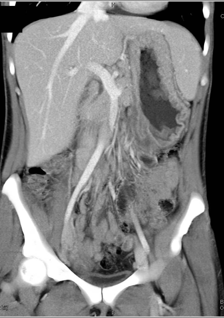 Gastric Lymphoma - CTisus CT Scan
