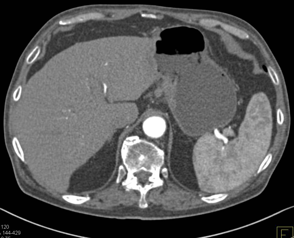 Carcinoma of the Gastric Antrum - CTisus CT Scan