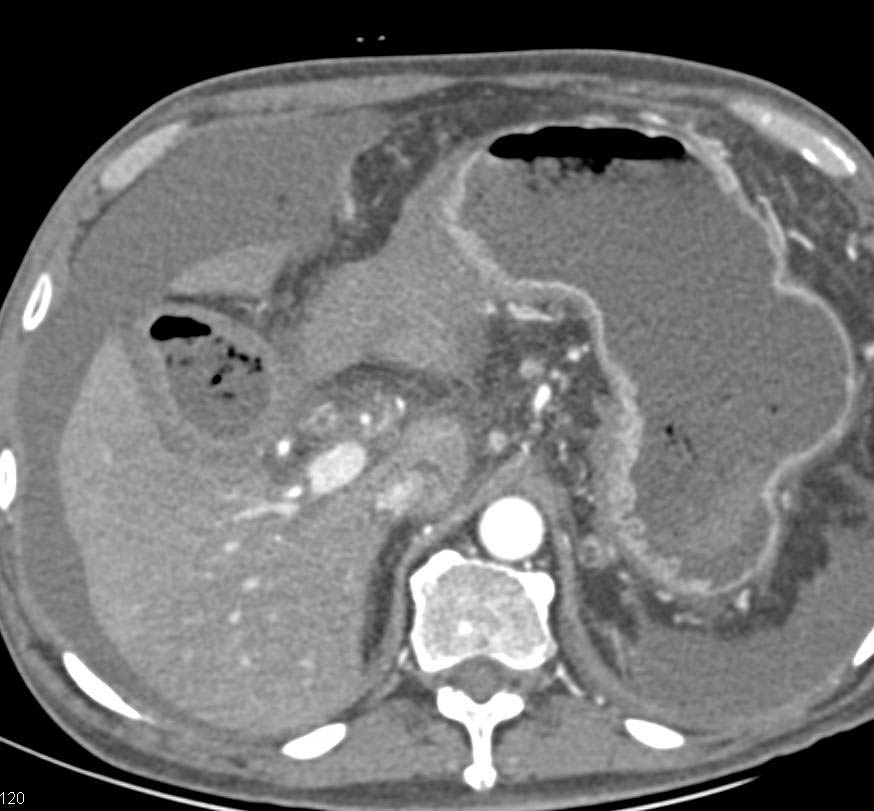 Antral Carcinoma with Carcinomatosis and Incidental Pulmonary Embolism - CTisus CT Scan