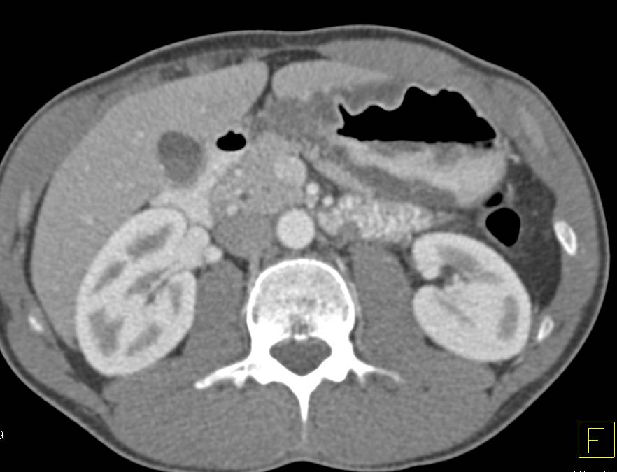 Antral Gastritis Simulates Gastric Adenocarcinoma - CTisus CT Scan
