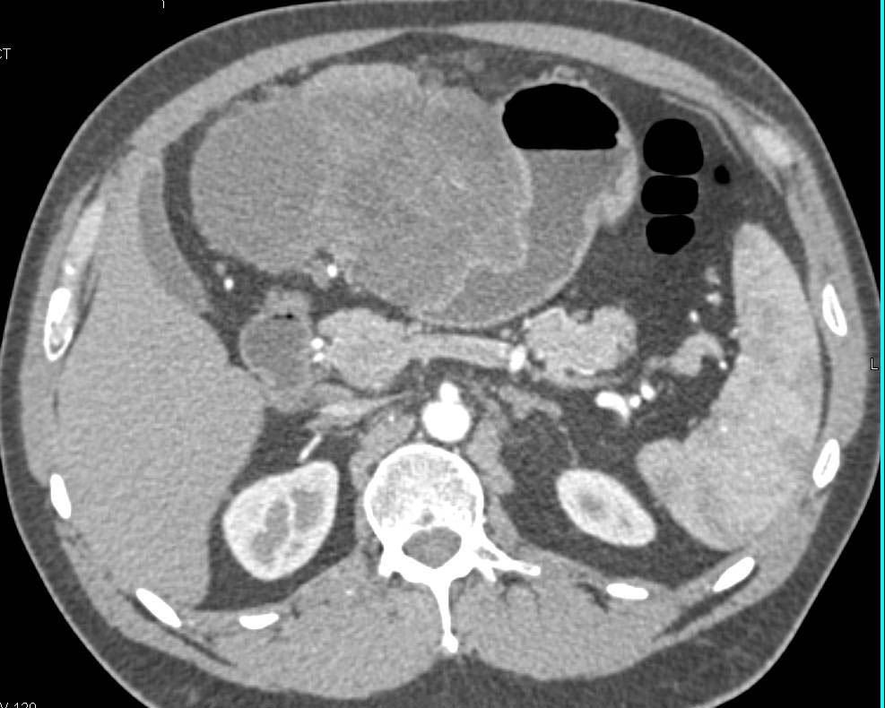 Gastric GIST Tumor - CTisus CT Scan