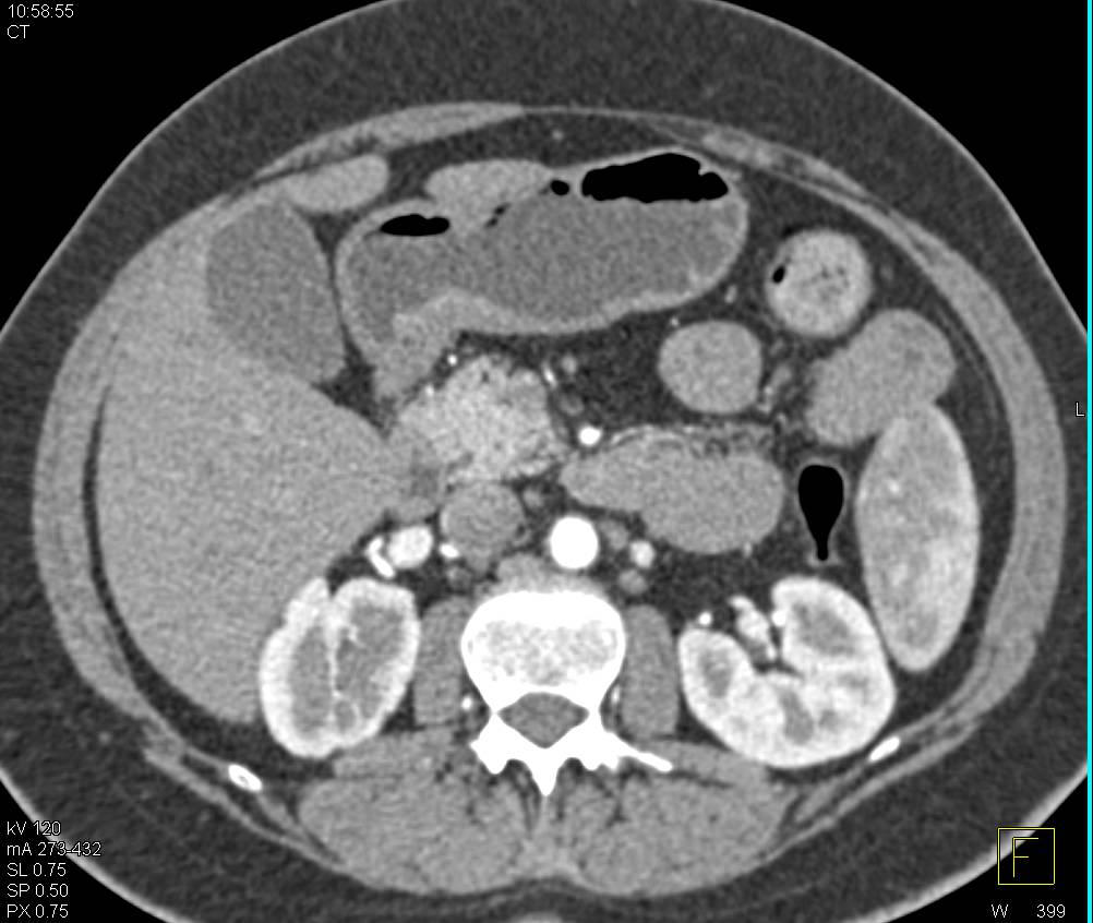 Perforated Antral Ulcer with Positive PET Scan but no Neoplasm on Biopsy - CTisus CT Scan