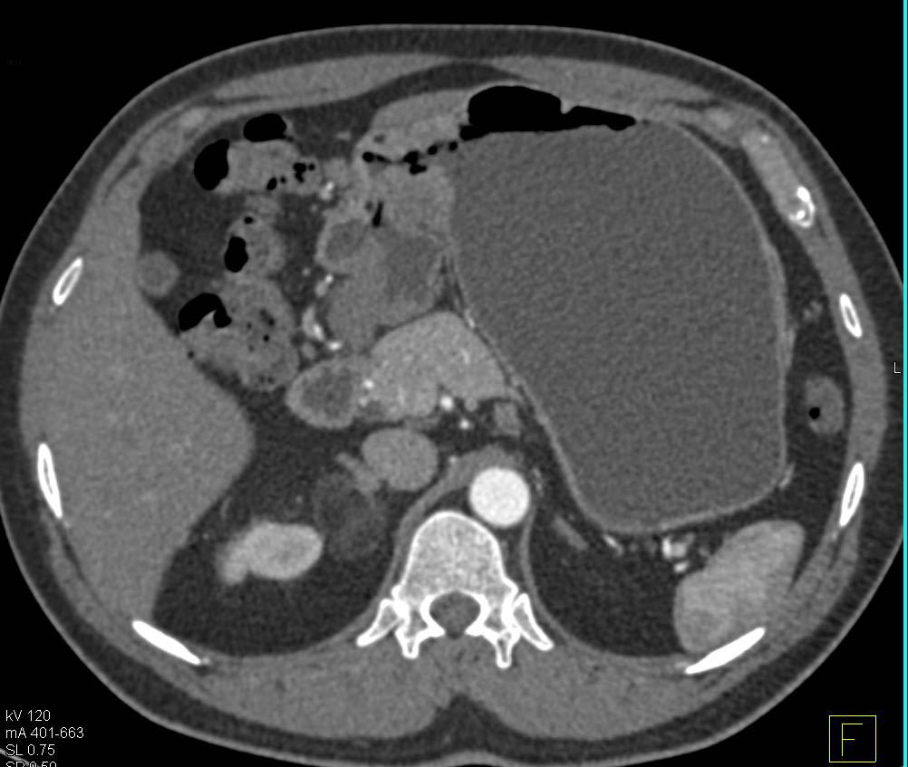 Carcinoma of the Gastric Antrum with an Incidental Right Adrenal Myelolipoma - CTisus CT Scan