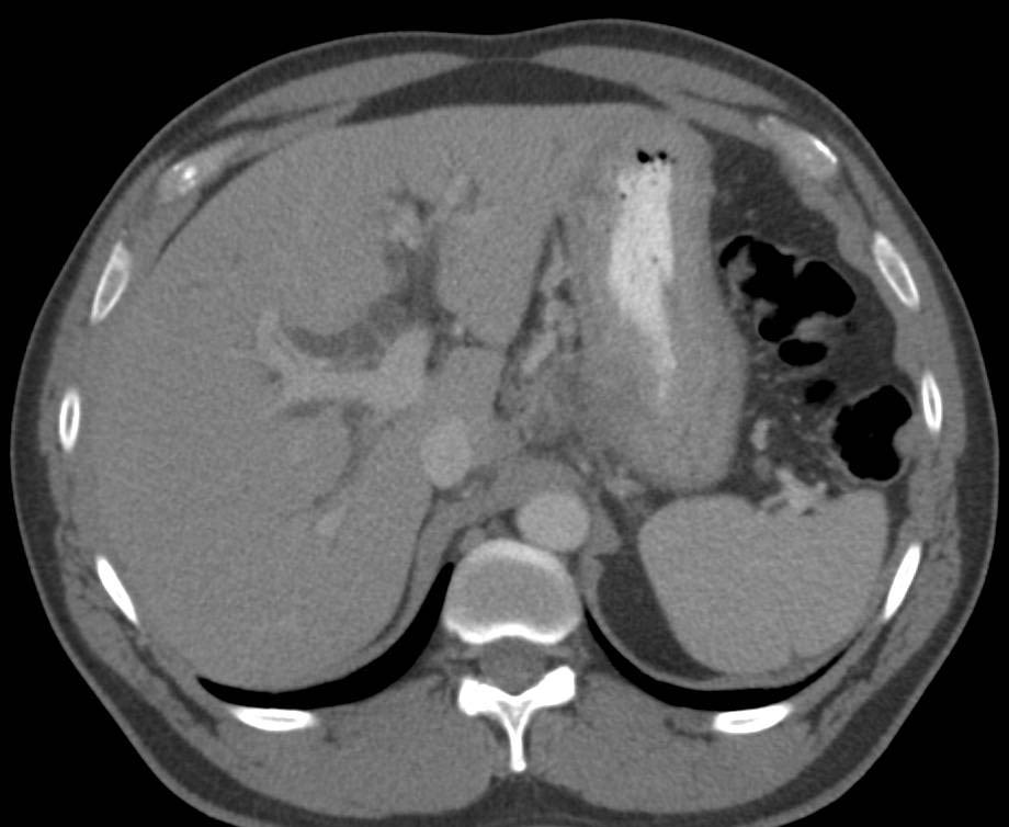 Gastric Adenocarcinoma with Extensive Adenopathy and PET Scan Correlation - CTisus CT Scan