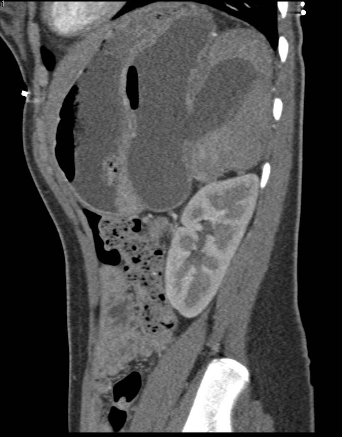 Pseudocyst in Lesser Sac - CTisus CT Scan