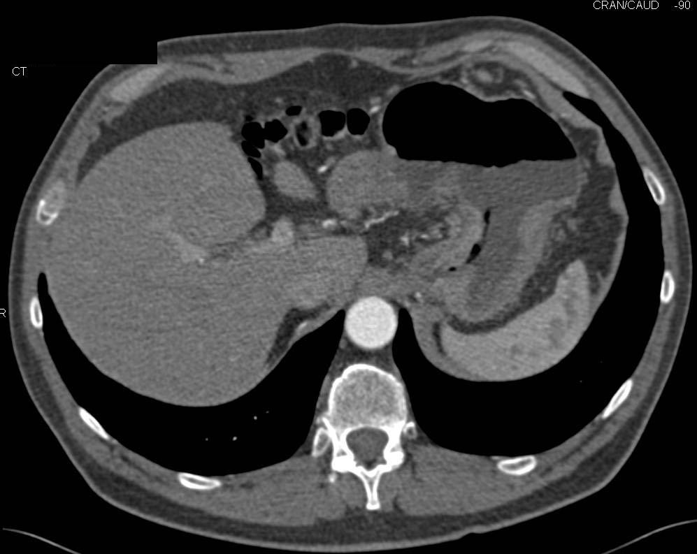 Adenocarcinoma of the Gastric Fundus - CTisus CT Scan