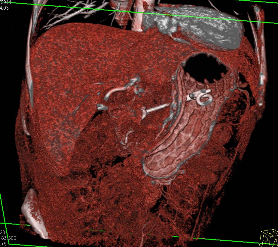Double J Stent Placed Through the Stomach into the Pseudocysst (Cystogastrostomy) - CTisus CT Scan