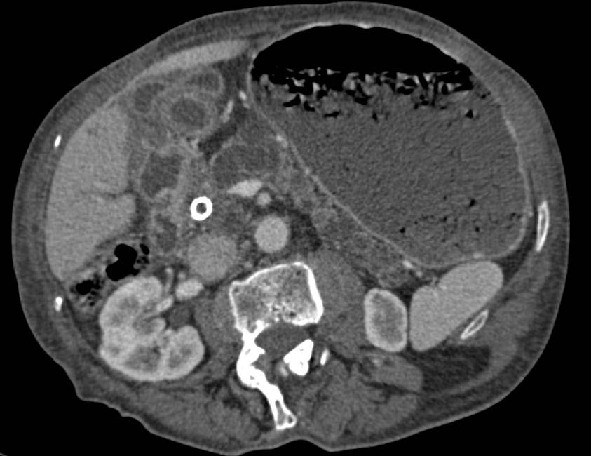 Pancreatic Cancer Causes Gastric Outlet Obstruction - CTisus CT Scan