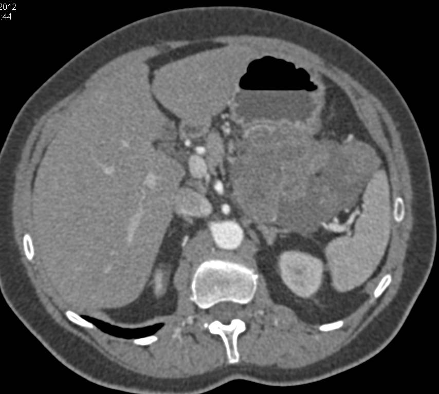 Gastric GIST Tumor - CTisus CT Scan