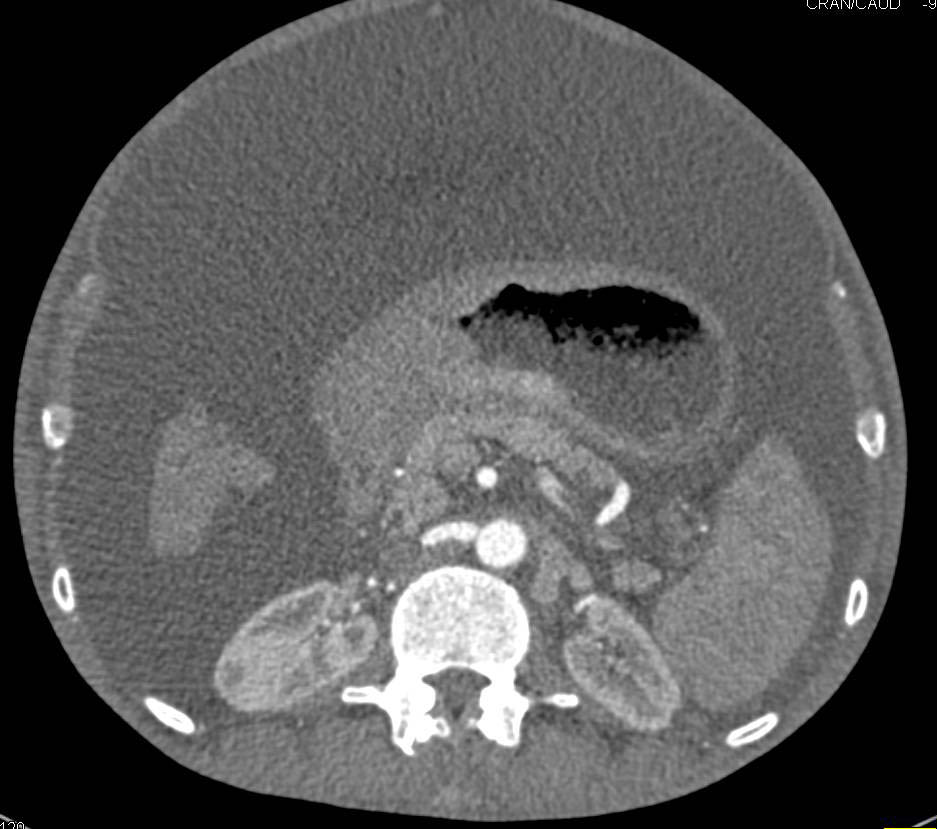 Infiltrating Gastric Cancer with Malignant Ascites - CTisus CT Scan