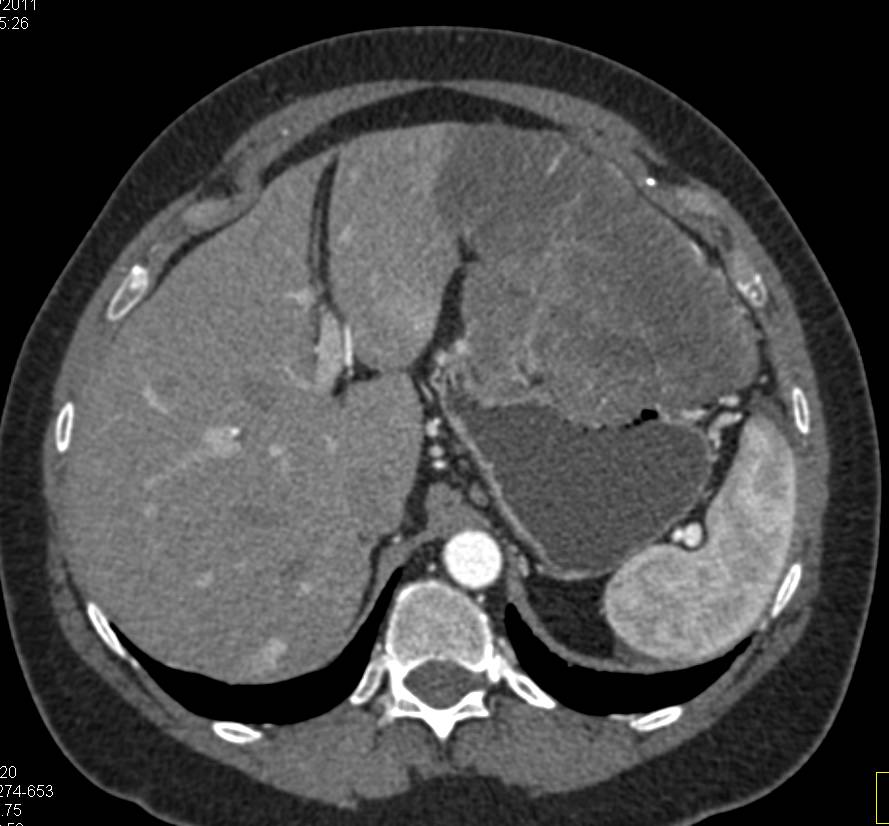 Large Cystic and Solid Gastric GIST Tumor - CTisus CT Scan