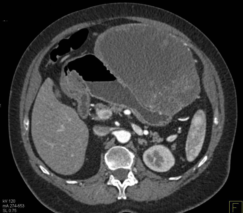 Gastric GIST Tumor - CTisus CT Scan