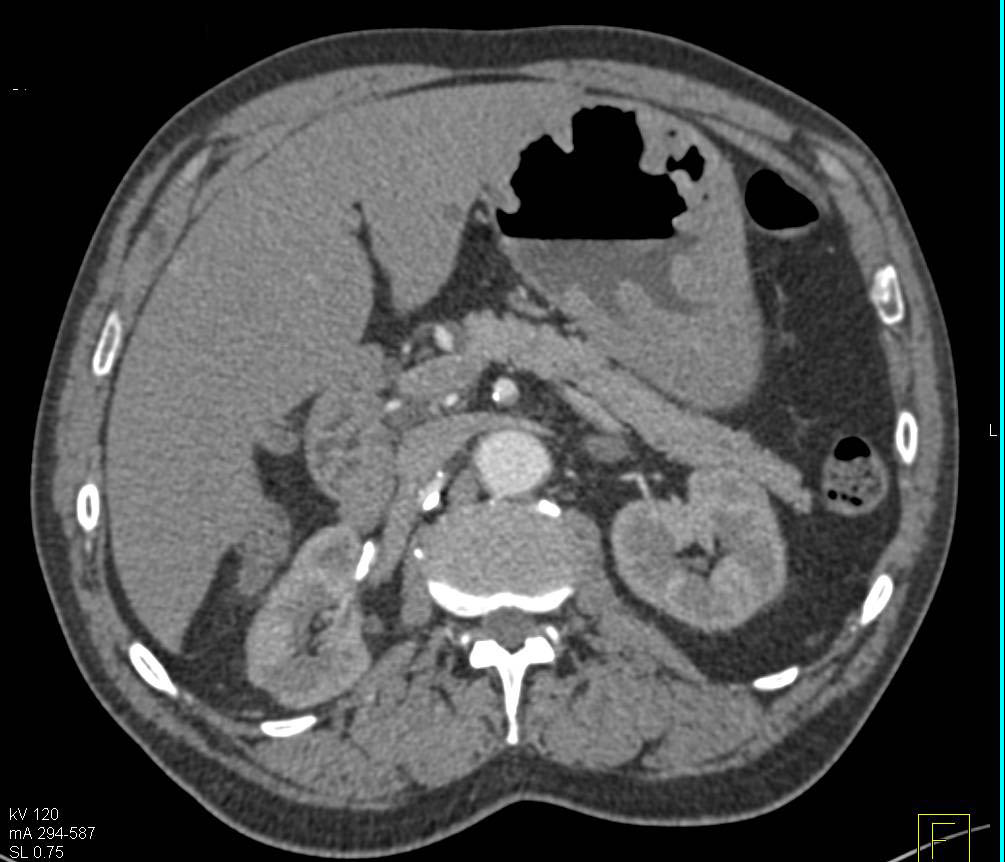 Zollinger-Ellison Syndrome with Thickened Gastric Folds - CTisus CT Scan