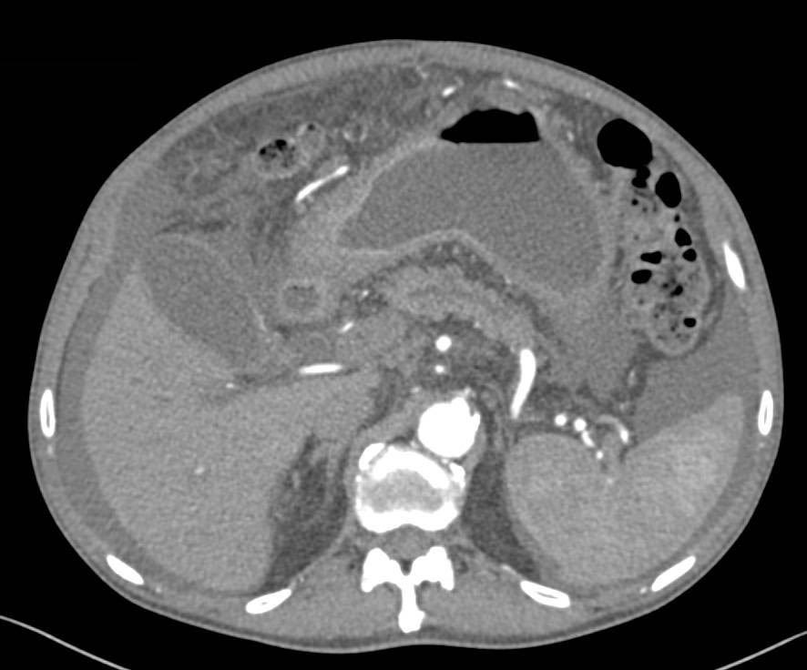 Gastric Carcinoma with Carcinomatosis - CTisus CT Scan
