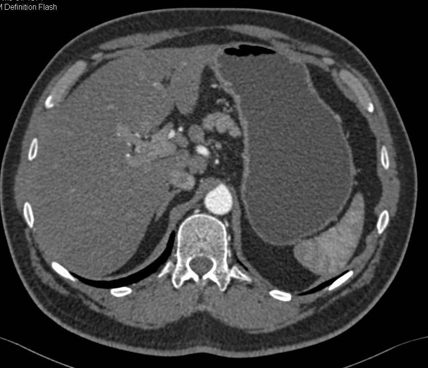 Carcinoma of the Gastric Antrum with Local Adenopathy - CTisus CT Scan