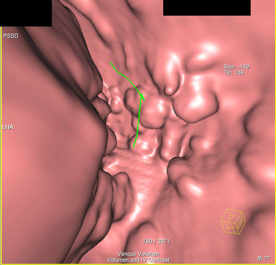Gastric Polyps on Virtual Endoscopy - CTisus CT Scan