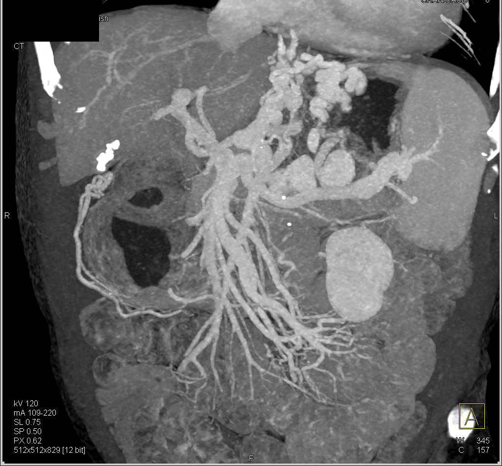 Cirrhosis with Portal Hypertension and Large Gastric Varices - CTisus CT Scan